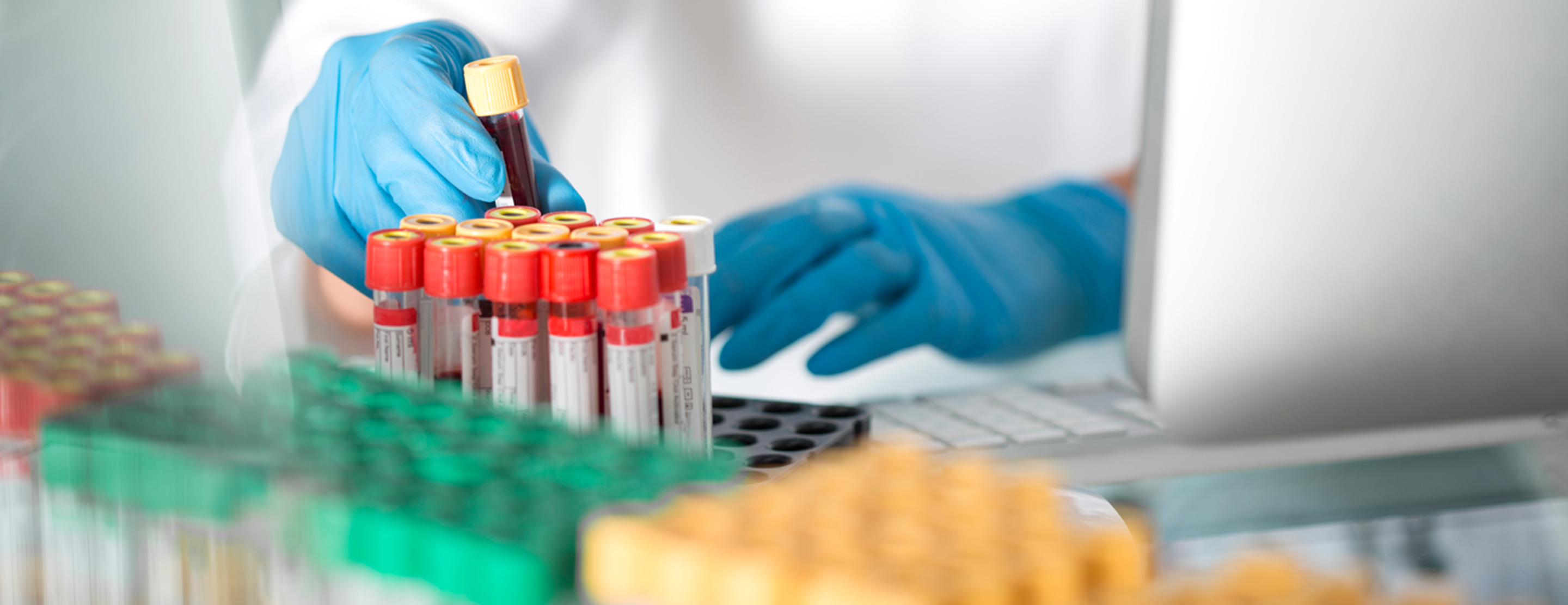 Aldosterone Blood Test