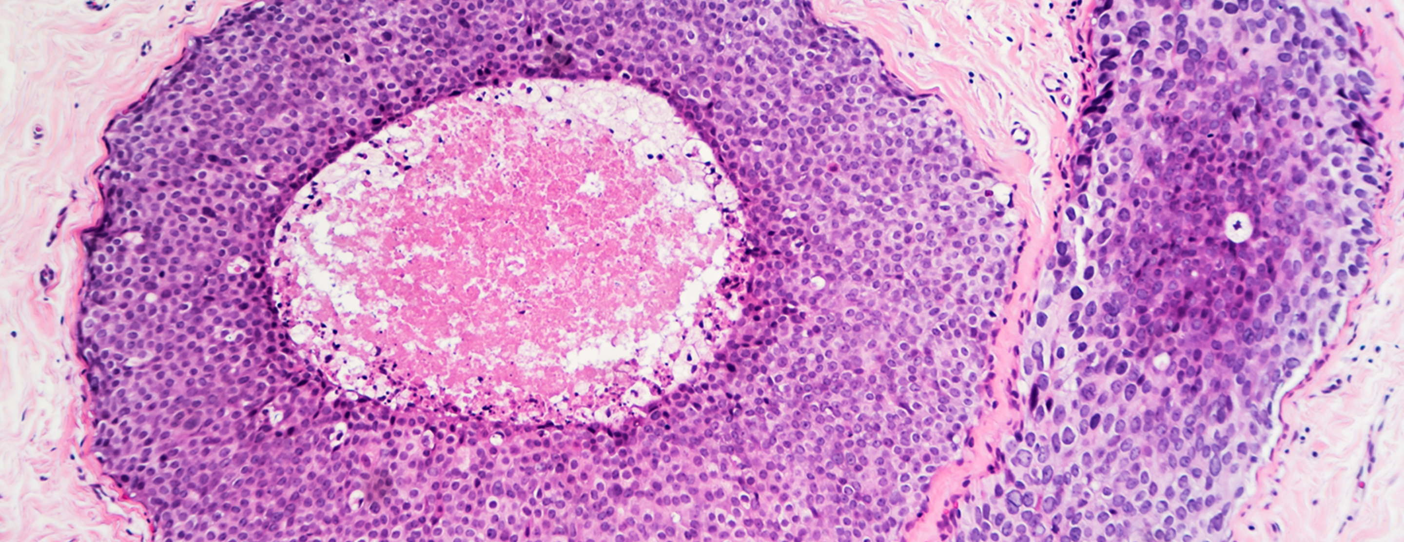 Fine Needle Aspiration (FNA) of the Breast