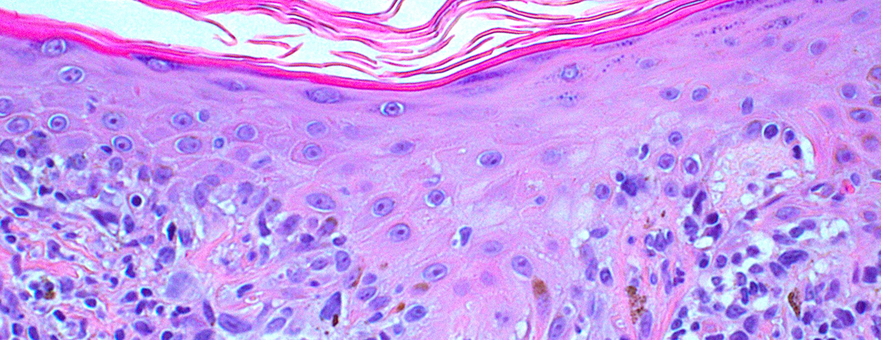 melanoma histology