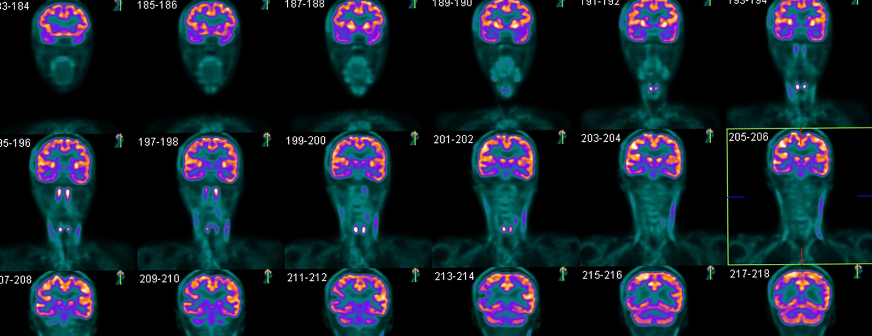 Brain PET Scan