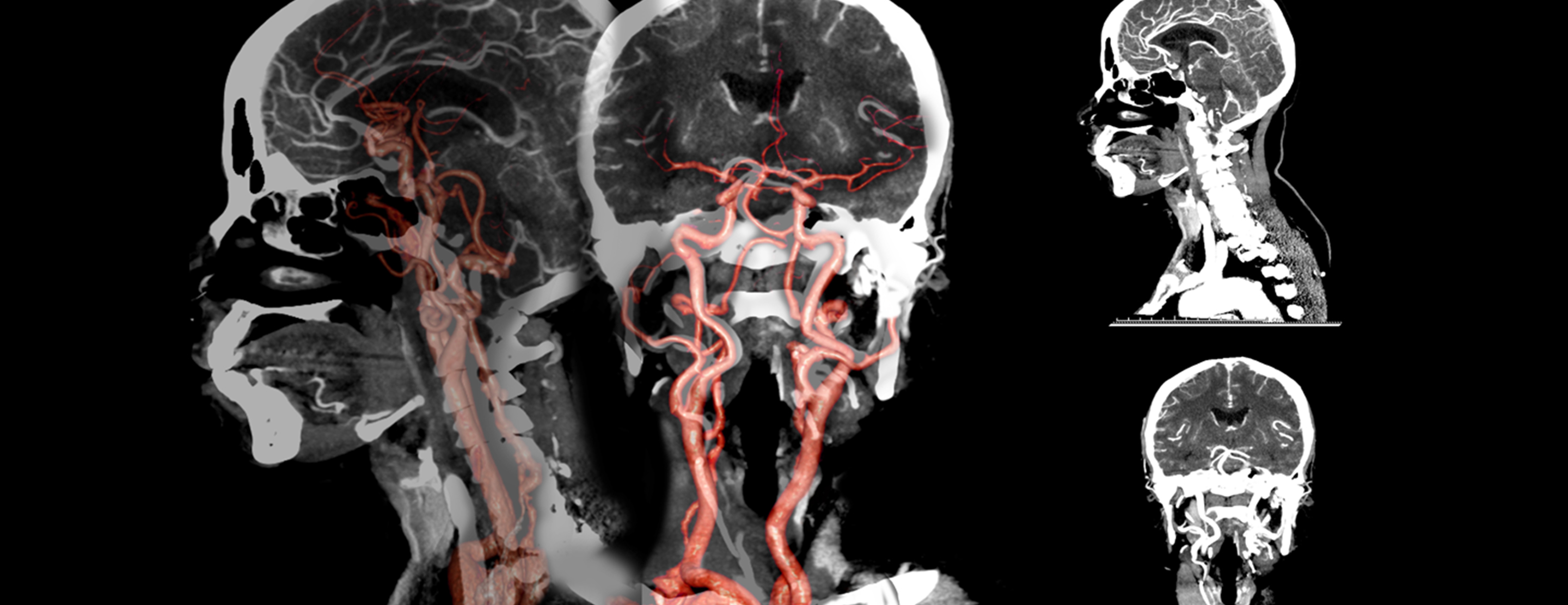 تصوير الأوعية الدموية للرأس والرقبة