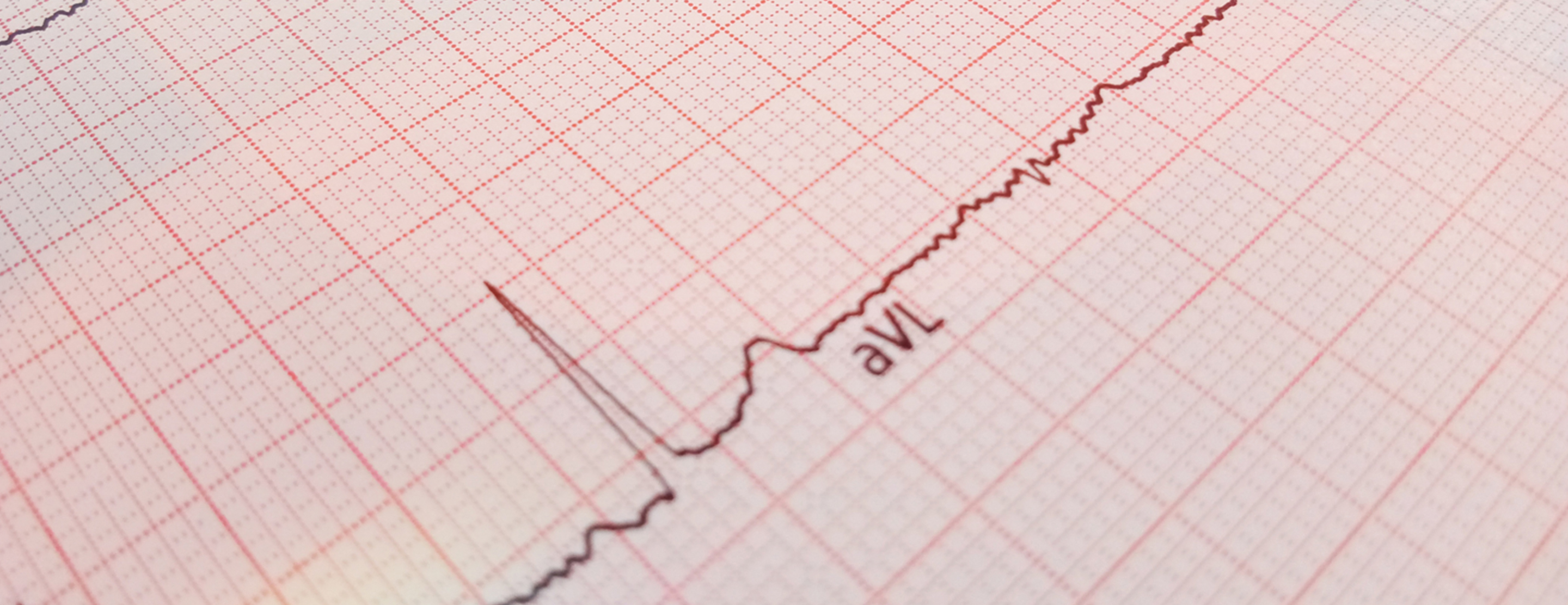 Electrocardiogram