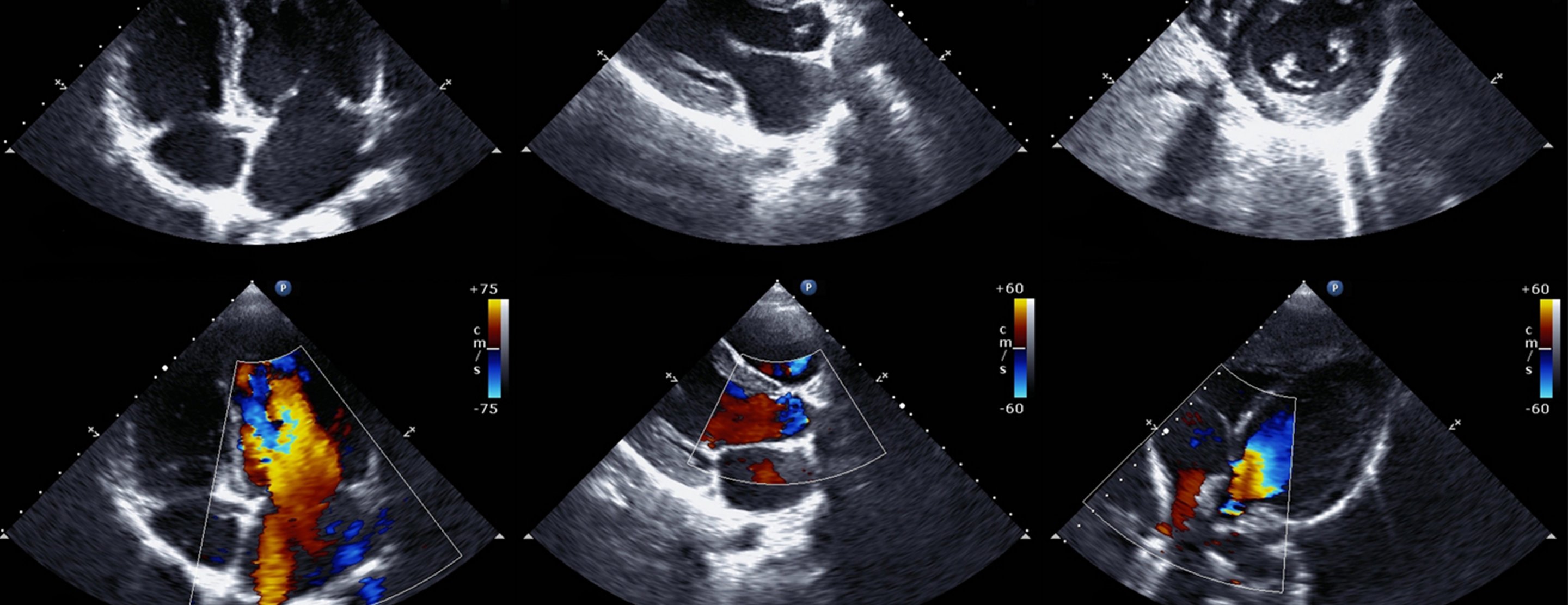 abnormal echocardiogram results