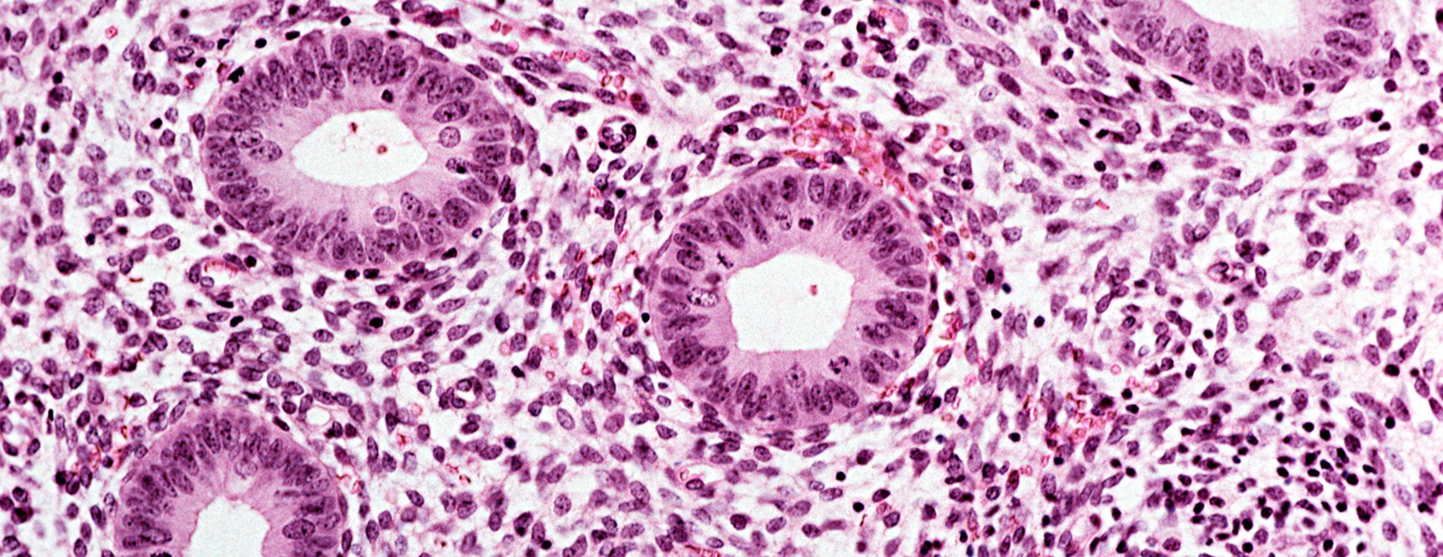 Endometrial Biopsy