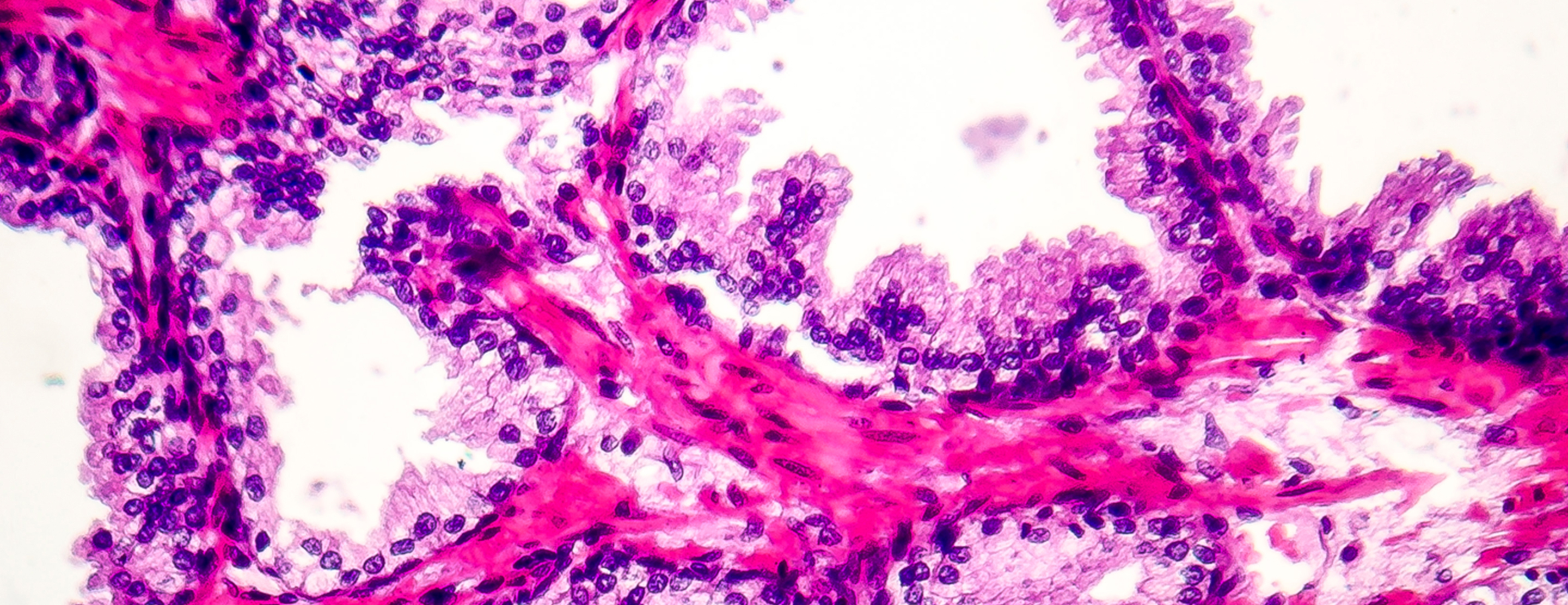 Define Hyperplasia With Example