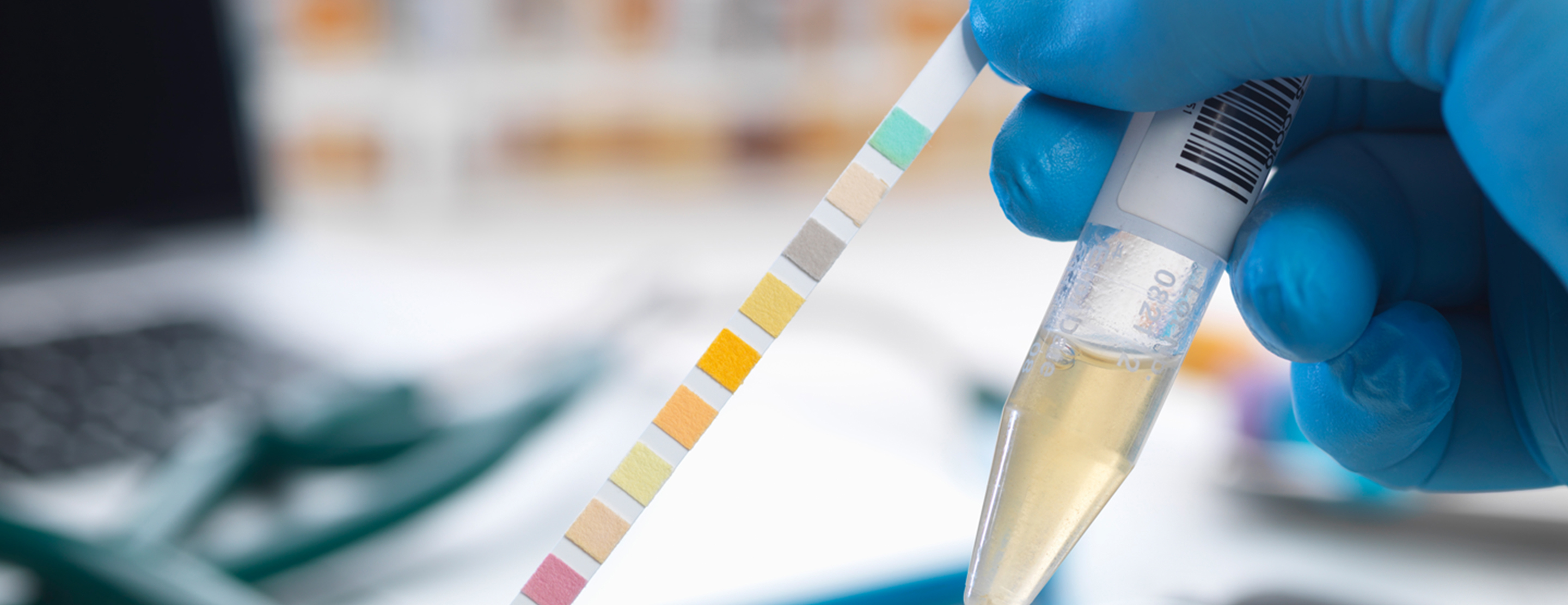 Urine Tests During Pregnancy: Why Urine Analysis Is So Important
