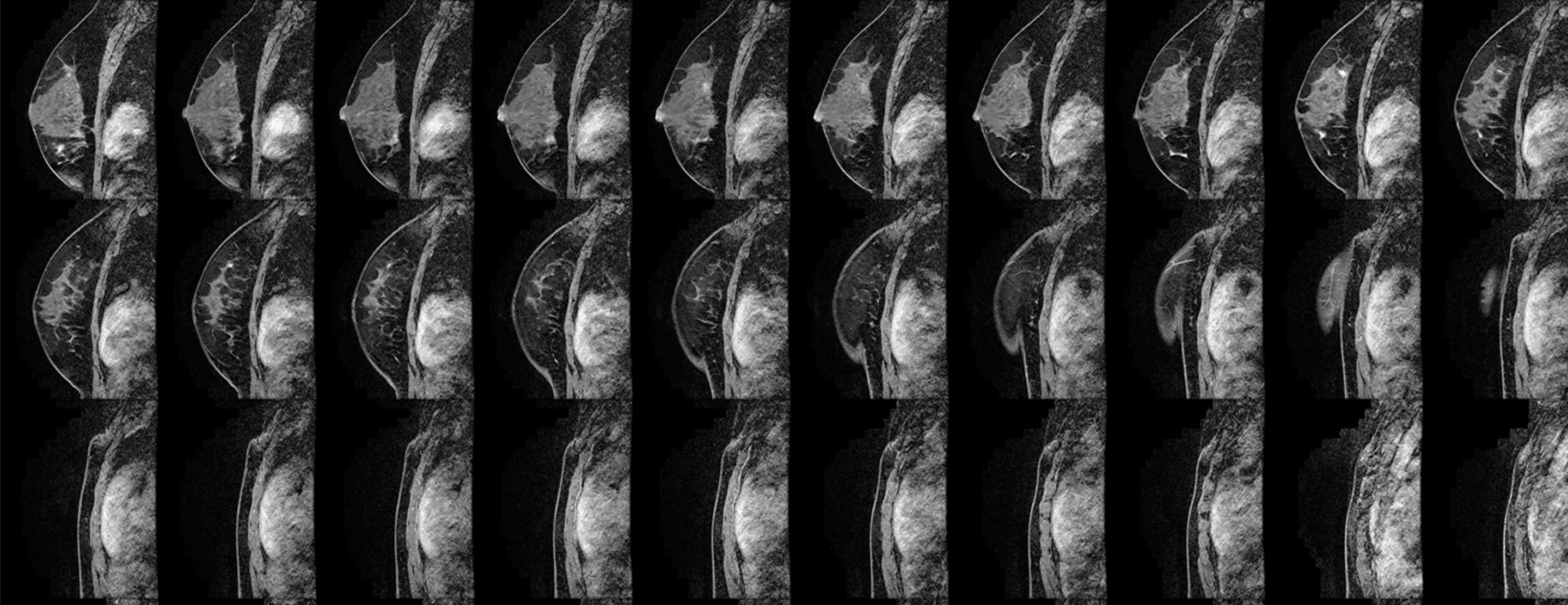 Biopsy For Breast Cancer Diagnosis MRI Guided Core UCSF Health