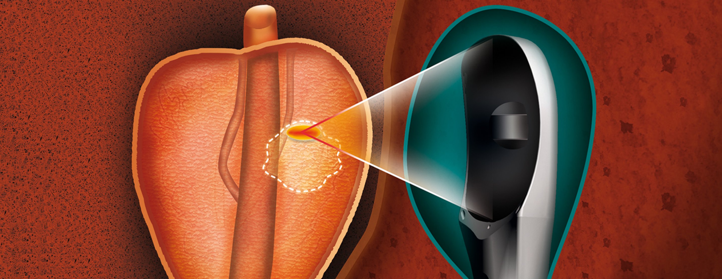 High Intensity Focused Ultrasound Hifu Conditions And Treatments Ucsf Health