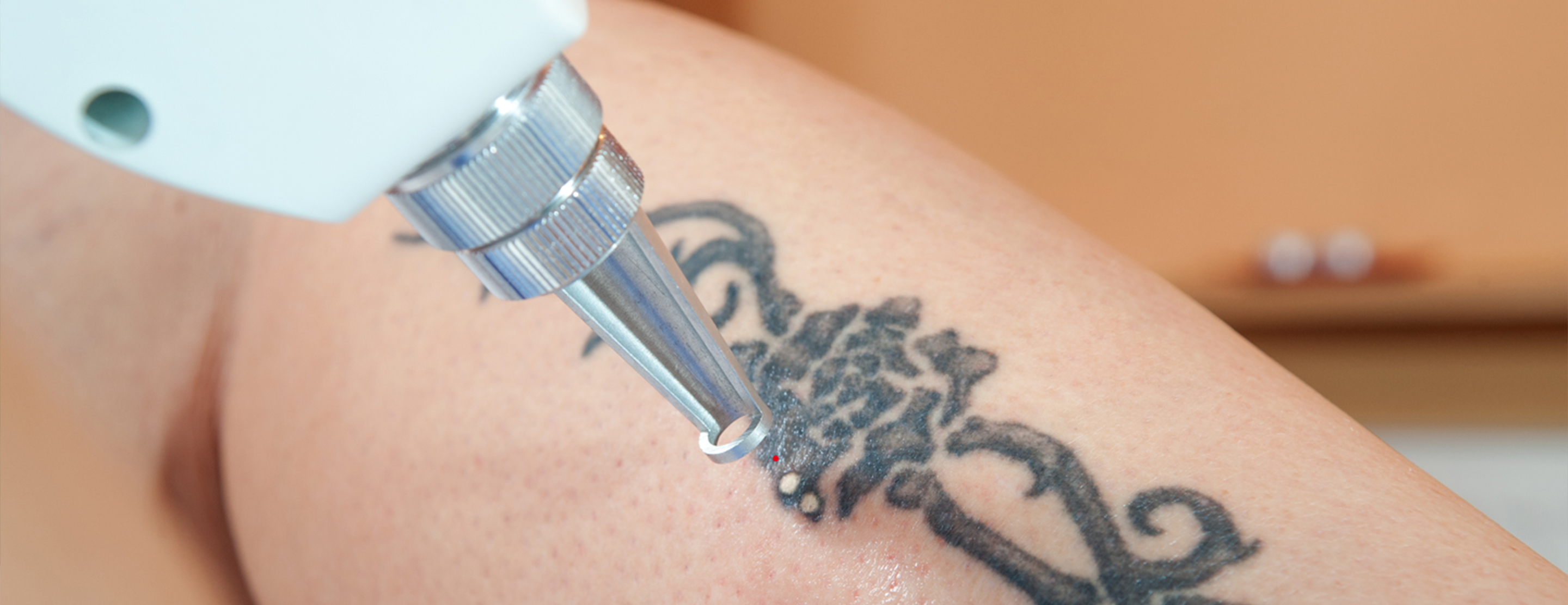 Potential Risks of Laser Tattoo Removal  Orange Coast Aesthetics