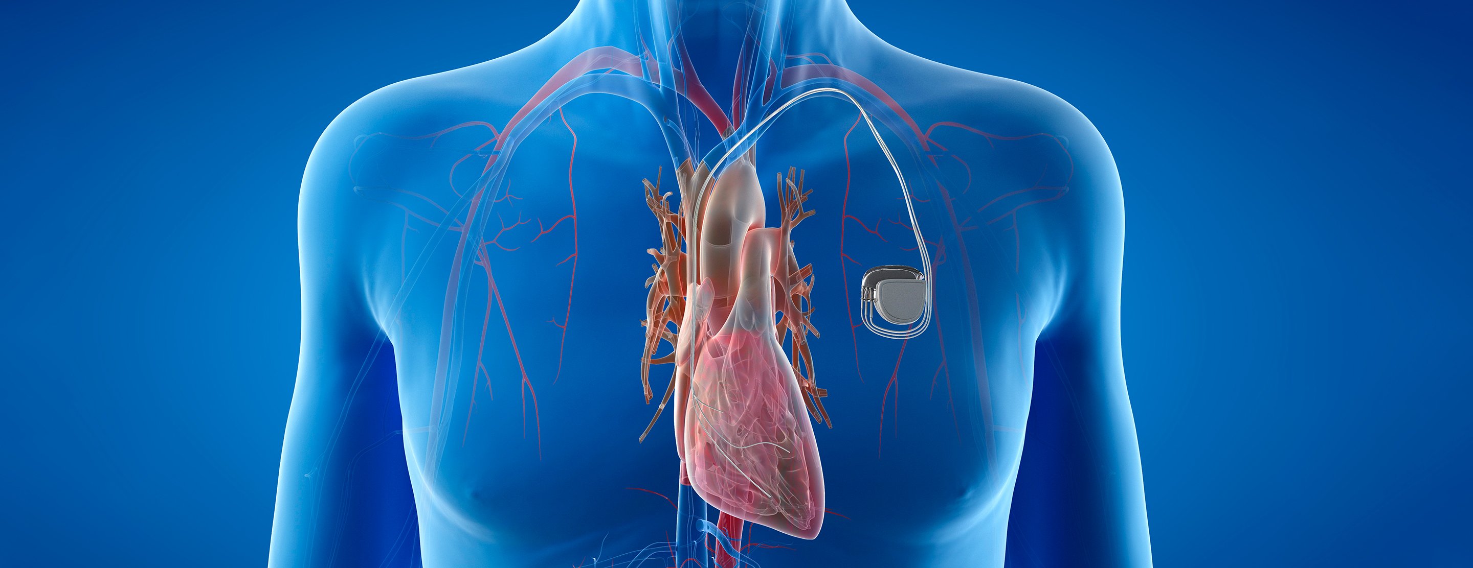 Cardiac Defibrillator Surgical Procedure