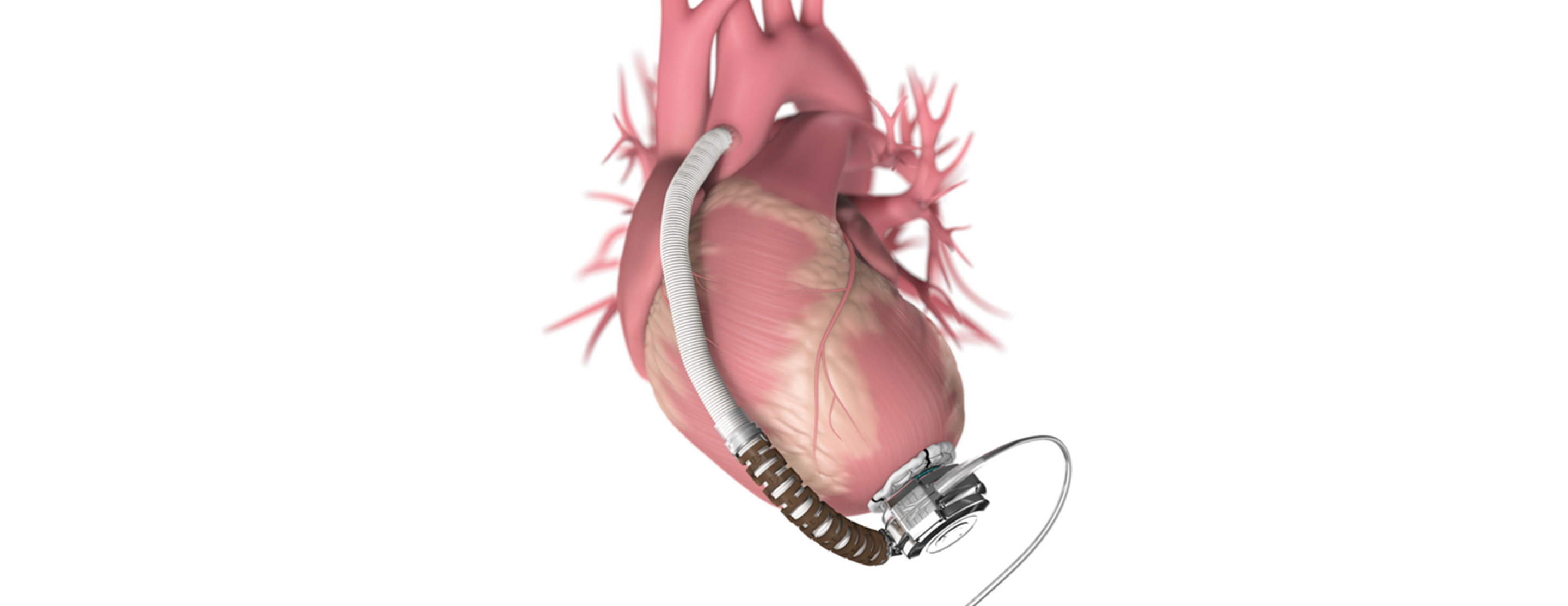 Improvement of left ventricular function assessment by global