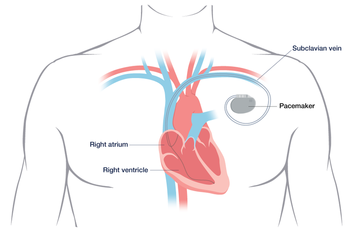 Pacemaker | Conditions & Treatments | UCSF Health